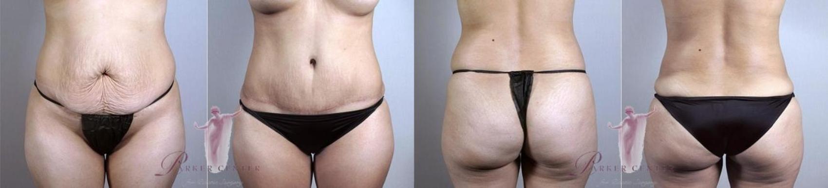 Liposuction Case 1138 Before & After Front | Paramus, NJ | Parker Center for Plastic Surgery