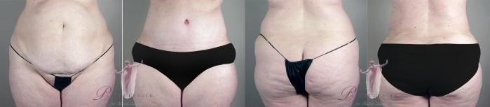 Liposuction Case 1139 Before & After Front | Paramus, NJ | Parker Center for Plastic Surgery