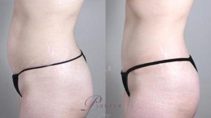 Tummy Tuck Case 1140 Before & After Left Side | Paramus, New Jersey | Parker Center for Plastic Surgery