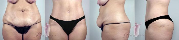 Liposuction Case 1141 Before & After Front | Paramus, NJ | Parker Center for Plastic Surgery