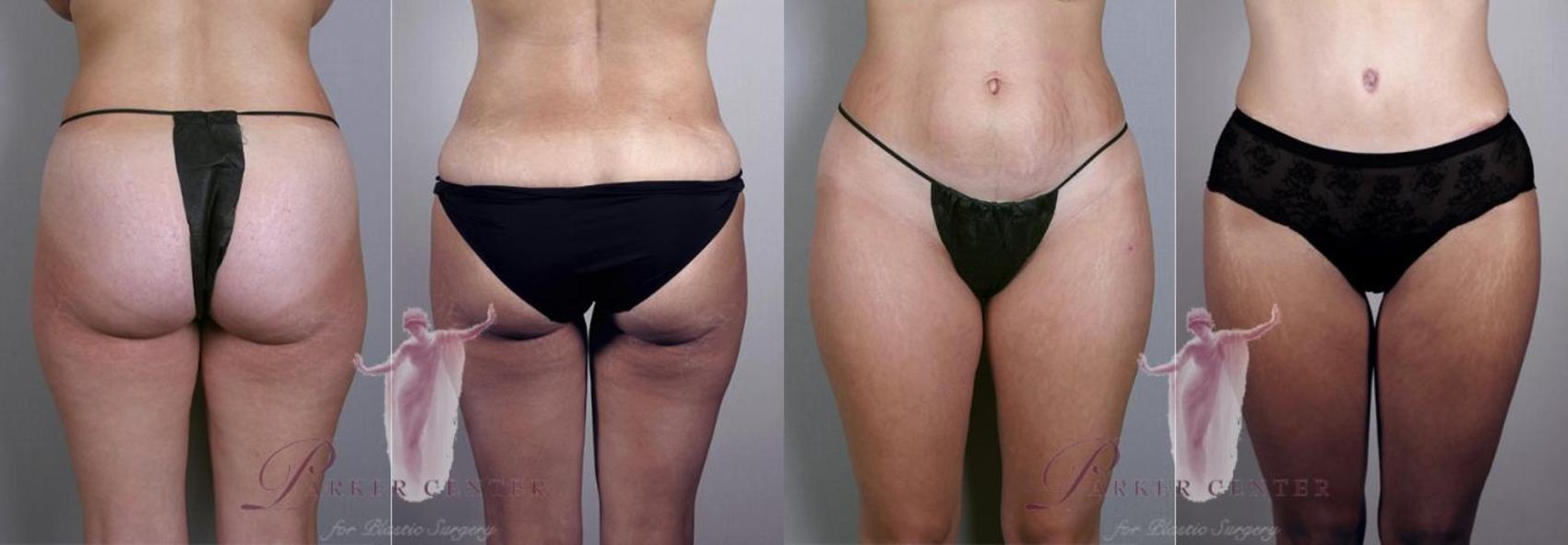 Tummy Tuck Case 1142 Before & After Front | Paramus, New Jersey | Parker Center for Plastic Surgery