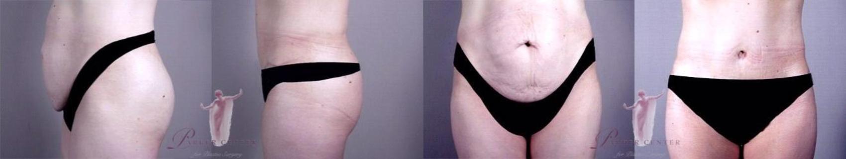 Tummy Tuck Case 1145 Before & After Front | Paramus, NJ | Parker Center for Plastic Surgery