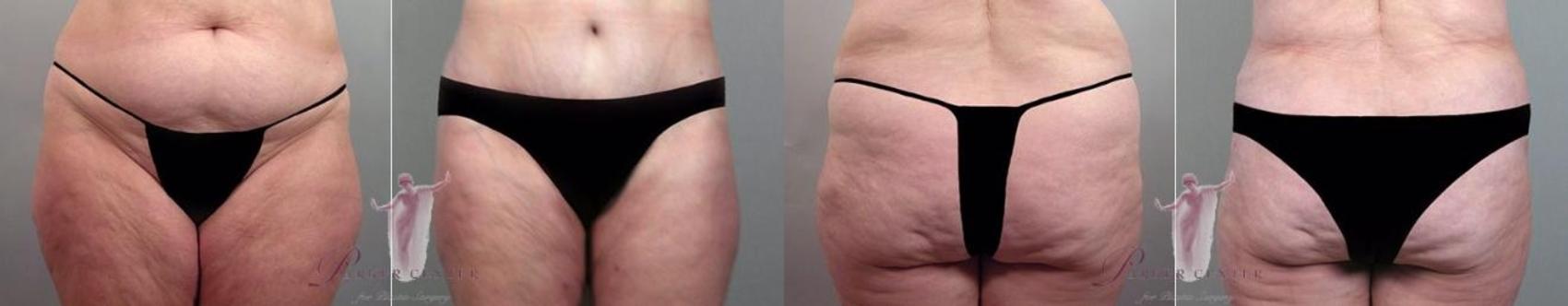 Liposuction Case 1147 Before & After Front | Paramus, NJ | Parker Center for Plastic Surgery