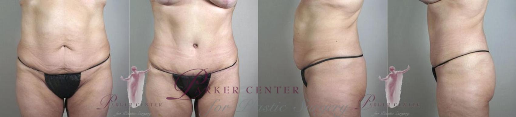 Body Lift Case 1148 Before & After Front | Paramus, NJ | Parker Center for Plastic Surgery