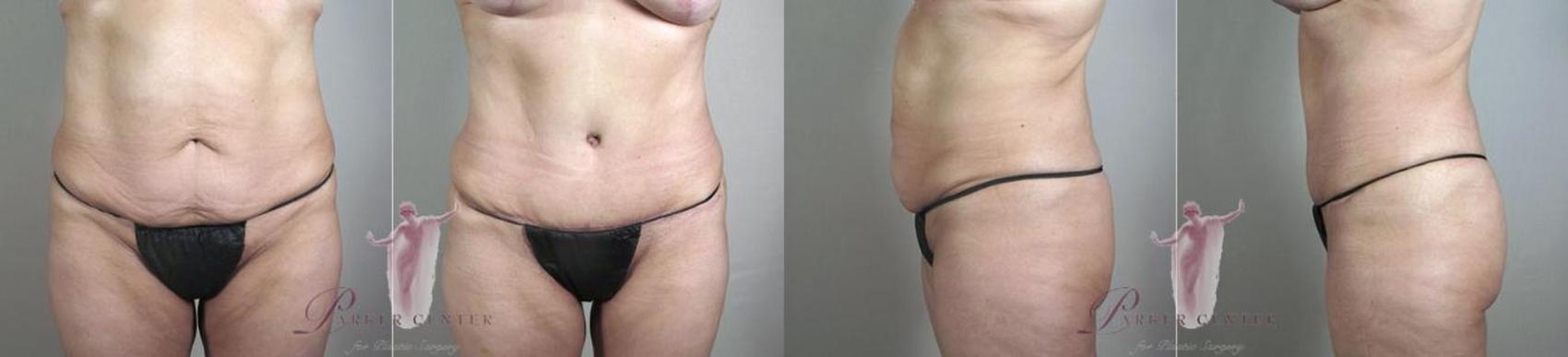 Tummy Tuck Case 1148 Before & After Front | Paramus, NJ | Parker Center for Plastic Surgery