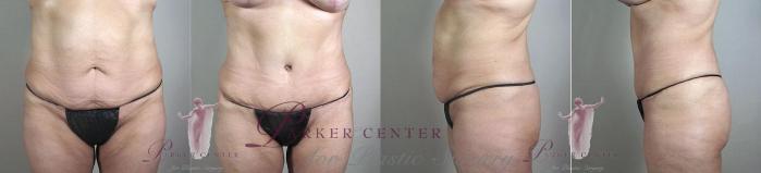 Body Lift Case 1148 Before & After Front | Paramus, NJ | Parker Center for Plastic Surgery