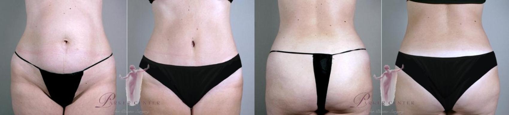 Liposuction Case 1149 Before & After Front | Paramus, New Jersey | Parker Center for Plastic Surgery