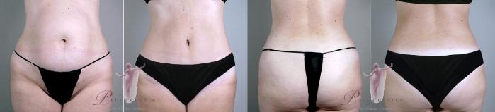 Liposuction Case 1149 Before & After Front | Paramus, NJ | Parker Center for Plastic Surgery