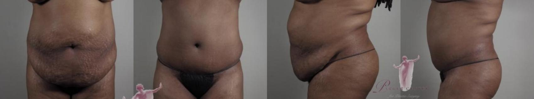 Tummy Tuck Case 1150 Before & After Front | Paramus, NJ | Parker Center for Plastic Surgery