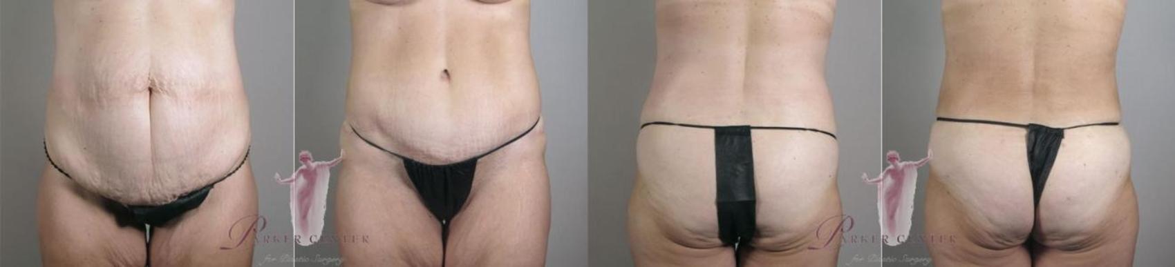 Liposuction Case 1151 Before & After Front | Paramus, NJ | Parker Center for Plastic Surgery