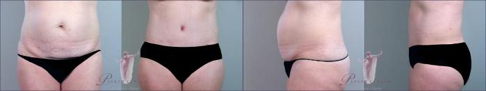 Liposuction Case 1153 Before & After Front | Paramus, NJ | Parker Center for Plastic Surgery