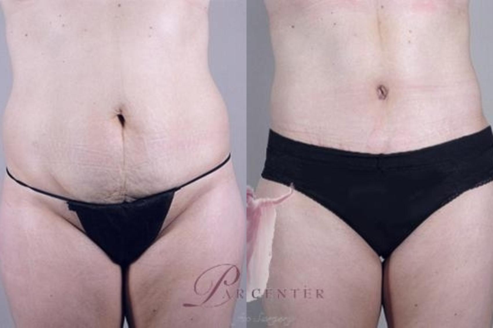 Tummy Tuck Case 1154 Before & After Front | Paramus, New Jersey | Parker Center for Plastic Surgery