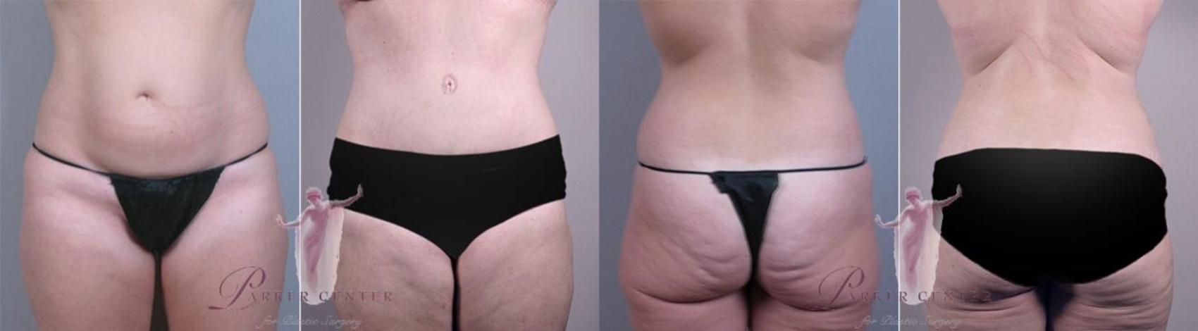 Tummy Tuck Case 1156 Before & After Front | Paramus, NJ | Parker Center for Plastic Surgery