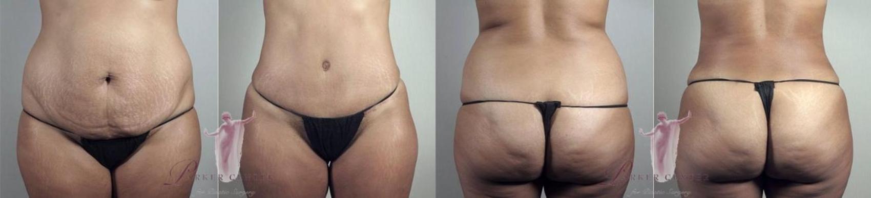 Liposuction Case 1158 Before & After Front | Paramus, NJ | Parker Center for Plastic Surgery