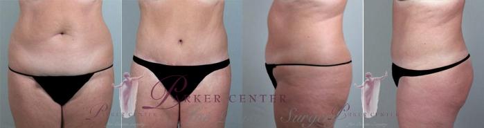 Tummy Tuck Case 1159 Before & After Front | Paramus, NJ | Parker Center for Plastic Surgery