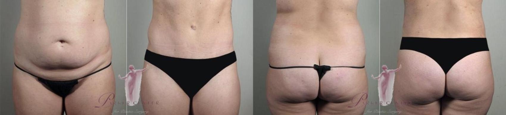 Tummy Tuck Case 1160 Before & After Front | Paramus, NJ | Parker Center for Plastic Surgery