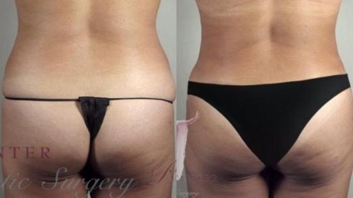 Tummy Tuck Case 1164 Before & After Back | Paramus, New Jersey | Parker Center for Plastic Surgery