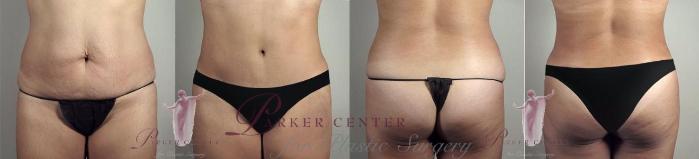 Tummy Tuck Case 1164 Before & After Front | Paramus, NJ | Parker Center for Plastic Surgery