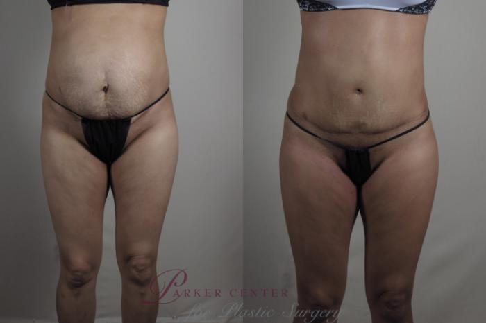 Liposuction Case 1221 Before & After View #1  | Paramus, NJ | Parker Center for Plastic Surgery