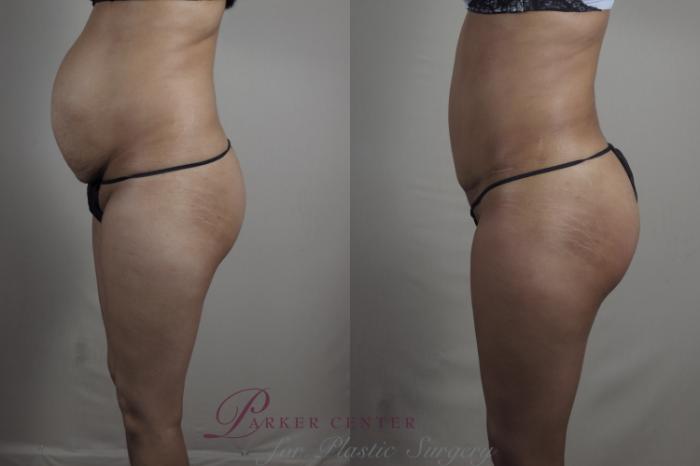 Liposuction Case 1221 Before & After View #2 | Paramus, NJ | Parker Center for Plastic Surgery