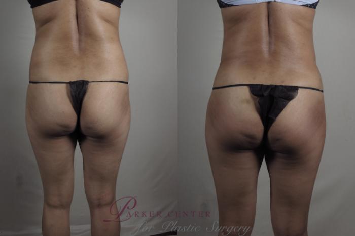 Liposuction Case 1221 Before & After View #3 | Paramus, NJ | Parker Center for Plastic Surgery