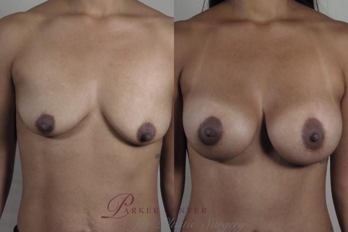 Liposuction Case 1300 Before & After front  | Paramus, NJ | Parker Center for Plastic Surgery
