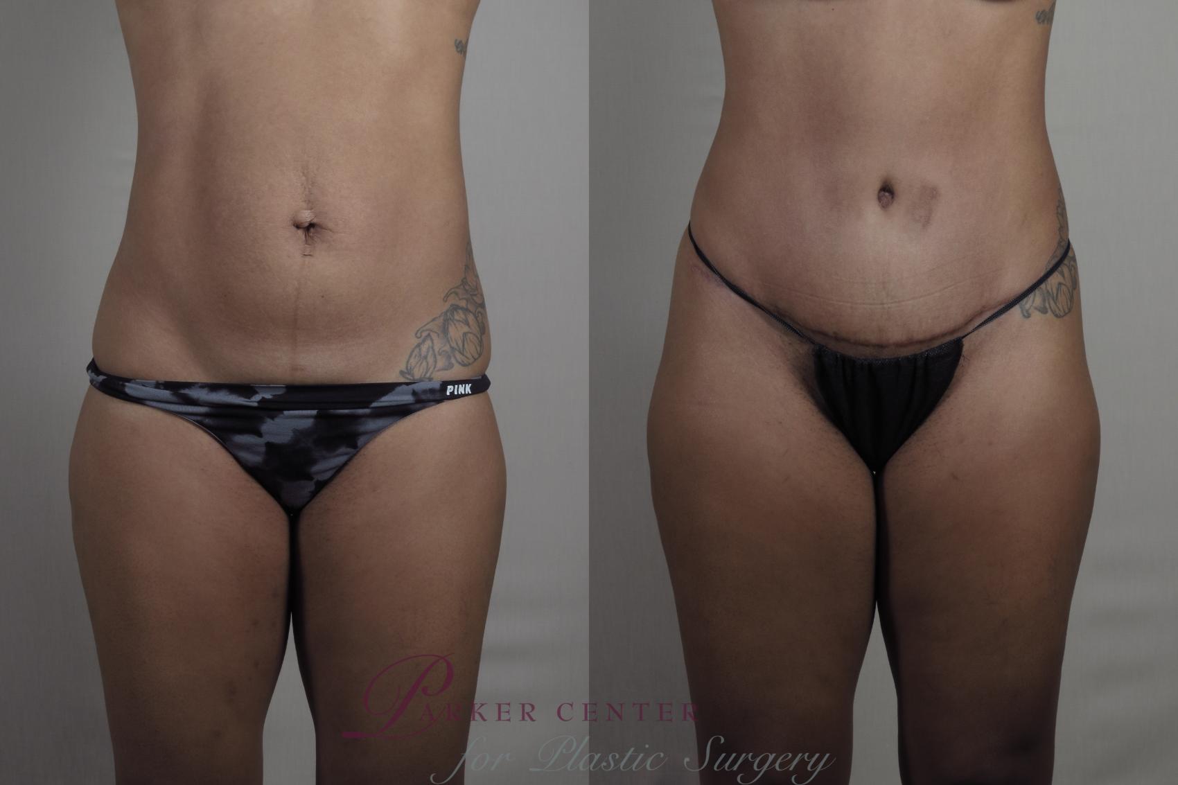 Liposuction Case 1300 Before & After Front | Paramus, NJ | Parker Center for Plastic Surgery