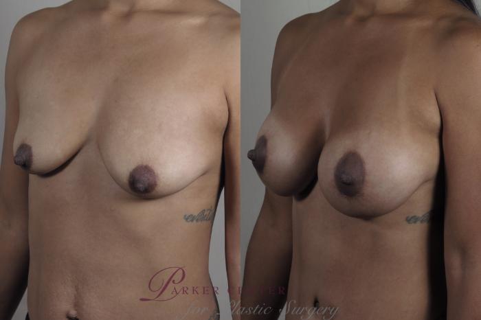 Liposuction Case 1300 Before & After Left Oblique | Paramus, NJ | Parker Center for Plastic Surgery