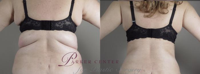 Liposuction Case 1317 Before & After back  | Paramus, NJ | Parker Center for Plastic Surgery