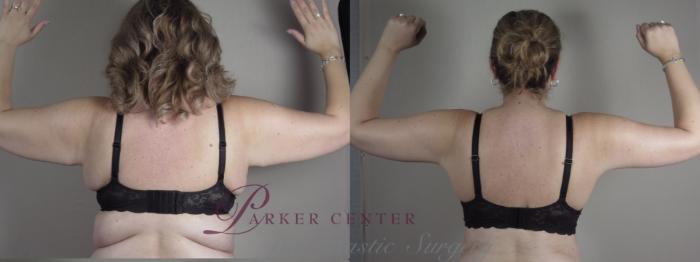 Liposuction Case 1317 Before & After Back | Paramus, NJ | Parker Center for Plastic Surgery
