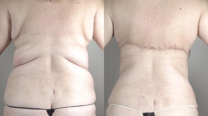 Tummy Tuck Case 1317 Before & After bra line | Paramus, New Jersey | Parker Center for Plastic Surgery