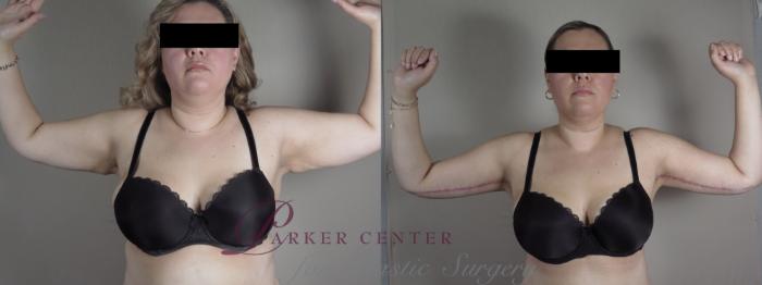 Liposuction Case 1317 Before & After front  | Paramus, NJ | Parker Center for Plastic Surgery