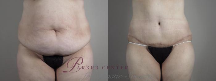 Tummy Tuck Case 1317 Before & After Front | Paramus, NJ | Parker Center for Plastic Surgery