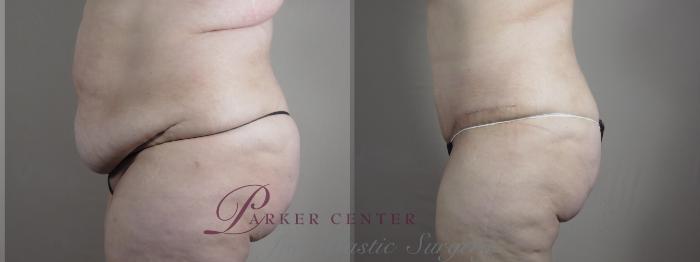Liposuction Case 1317 Before & After Left Side | Paramus, NJ | Parker Center for Plastic Surgery