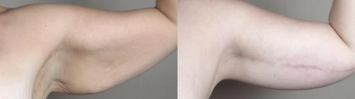 Tummy Tuck Case 1319 Before & After arms 1 | Paramus, New Jersey | Parker Center for Plastic Surgery