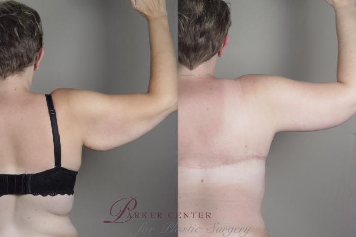 Liposuction Case 1319 Before & After back  | Paramus, NJ | Parker Center for Plastic Surgery