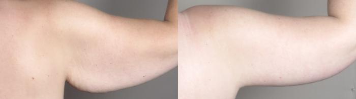 Tummy Tuck Case 1319 Before & After back arms 1 | Paramus, New Jersey | Parker Center for Plastic Surgery