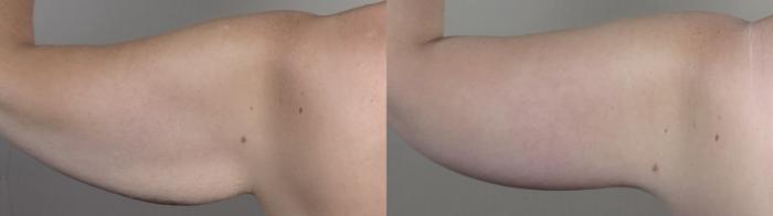 Tummy Tuck Case 1319 Before & After back arms | Paramus, New Jersey | Parker Center for Plastic Surgery