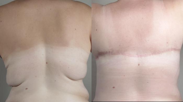 Tummy Tuck Case 1319 Before & After bra line 2 | Paramus, New Jersey | Parker Center for Plastic Surgery