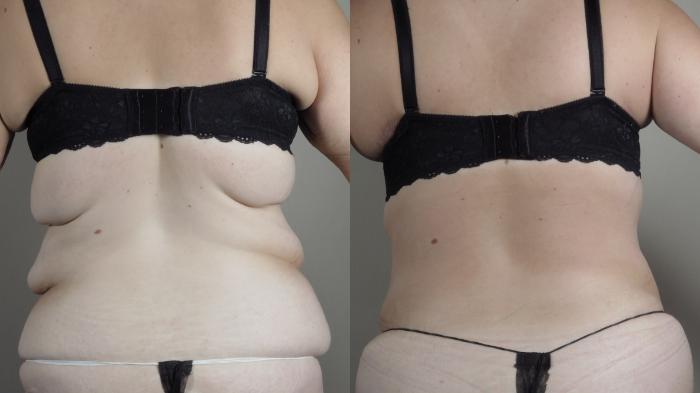 Tummy Tuck Case 1319 Before & After bra line | Paramus, New Jersey | Parker Center for Plastic Surgery