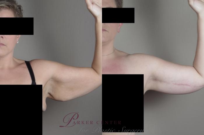 Liposuction Case 1319 Before & After front  | Paramus, NJ | Parker Center for Plastic Surgery