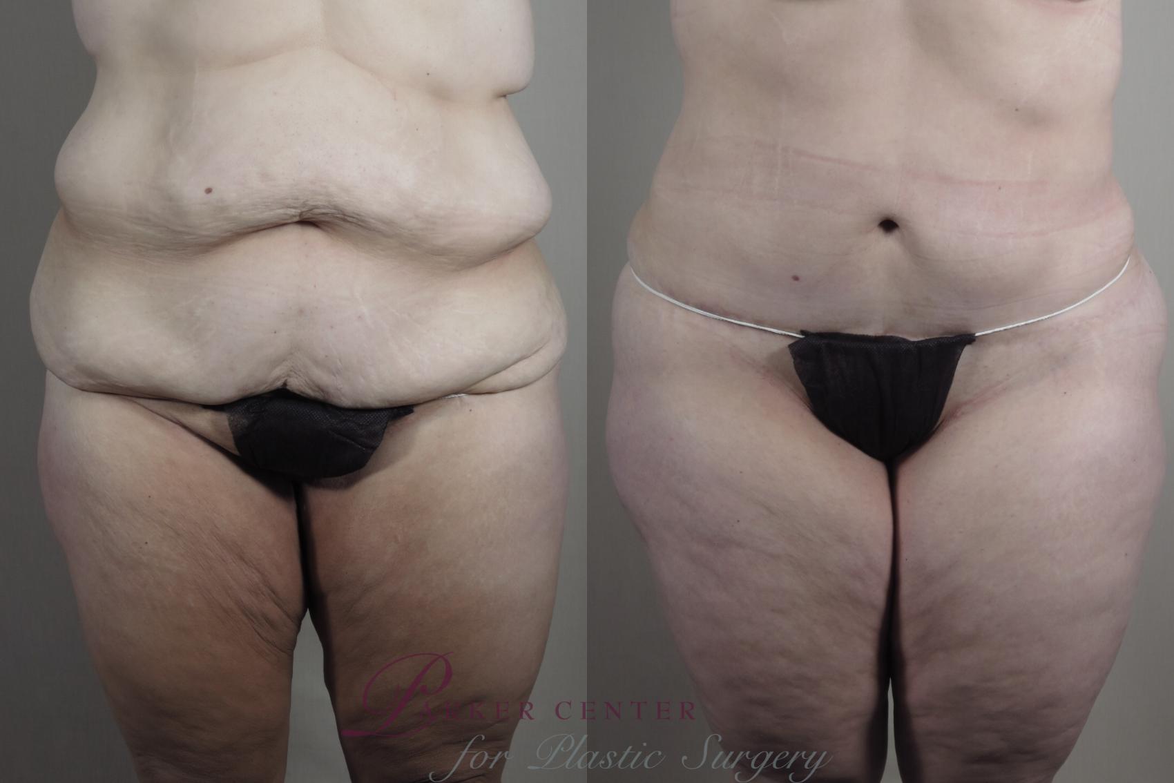 Liposuction Case 1319 Before & After Front | Paramus, NJ | Parker Center for Plastic Surgery