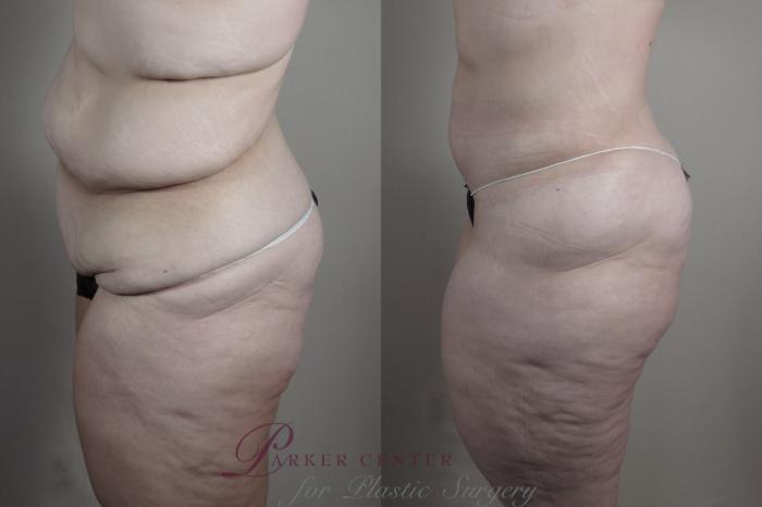 Liposuction Case 1319 Before & After Left Side | Paramus, NJ | Parker Center for Plastic Surgery