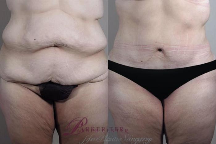 Liposuction Case 1333 Before & After Front | Paramus, NJ | Parker Center for Plastic Surgery