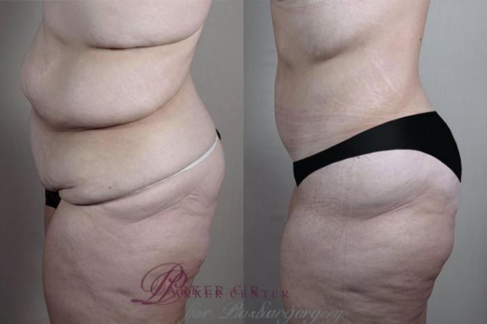 Liposuction Case 1333 Before & After Left Side | Paramus, NJ | Parker Center for Plastic Surgery