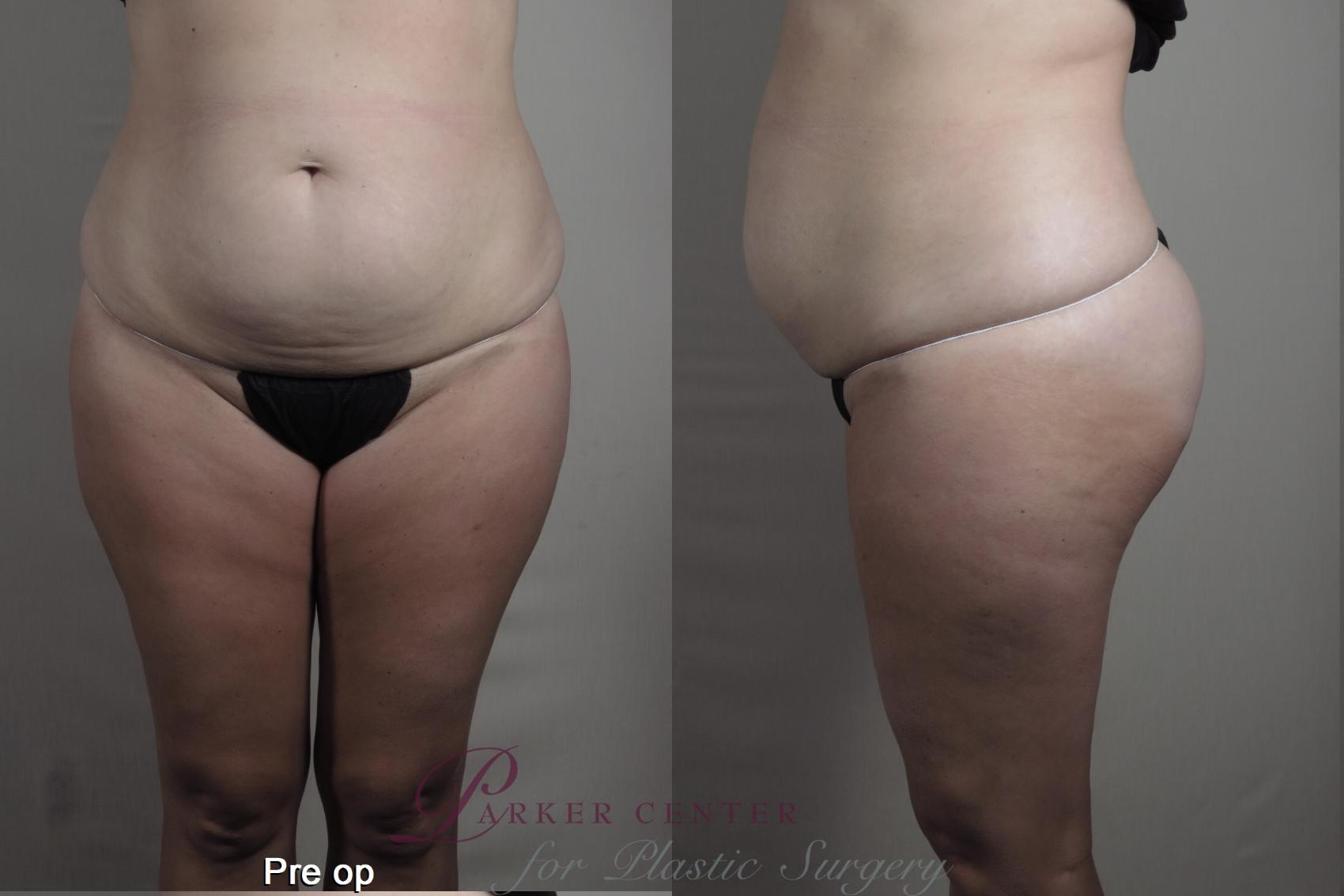 Tummy Tuck Case 1362 Before & After pre op  | Paramus, New Jersey | Parker Center for Plastic Surgery