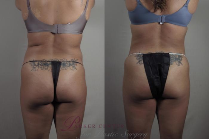 Liposuction Case 1371 Before & After Back | Paramus, NJ | Parker Center for Plastic Surgery