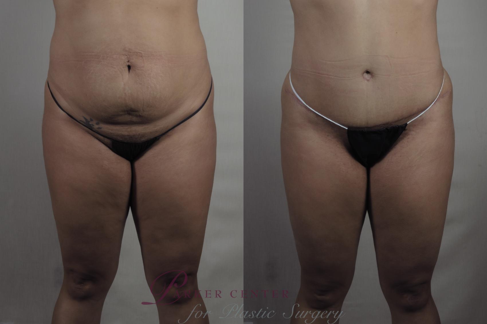 Liposuction Case 1371 Before & After Front | Paramus, NJ | Parker Center for Plastic Surgery