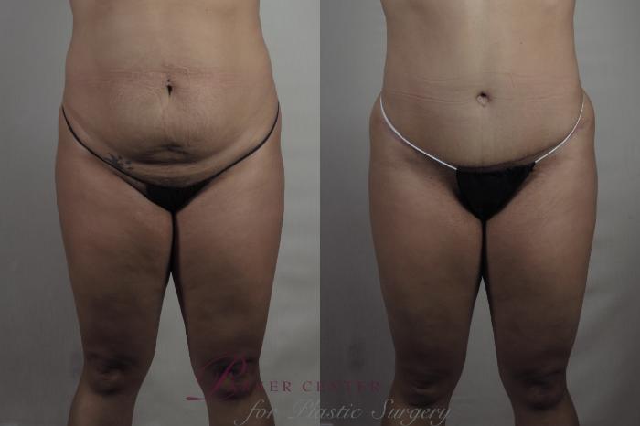 Liposuction Case 1371 Before & After Front | Paramus, NJ | Parker Center for Plastic Surgery