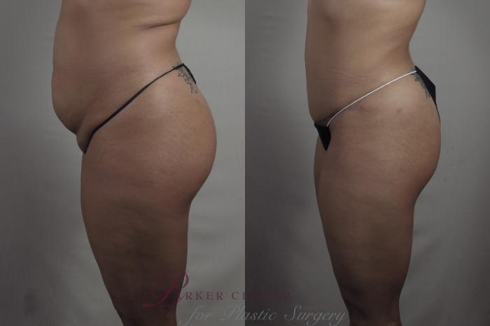 Liposuction Case 1371 Before & After Left Side | Paramus, NJ | Parker Center for Plastic Surgery